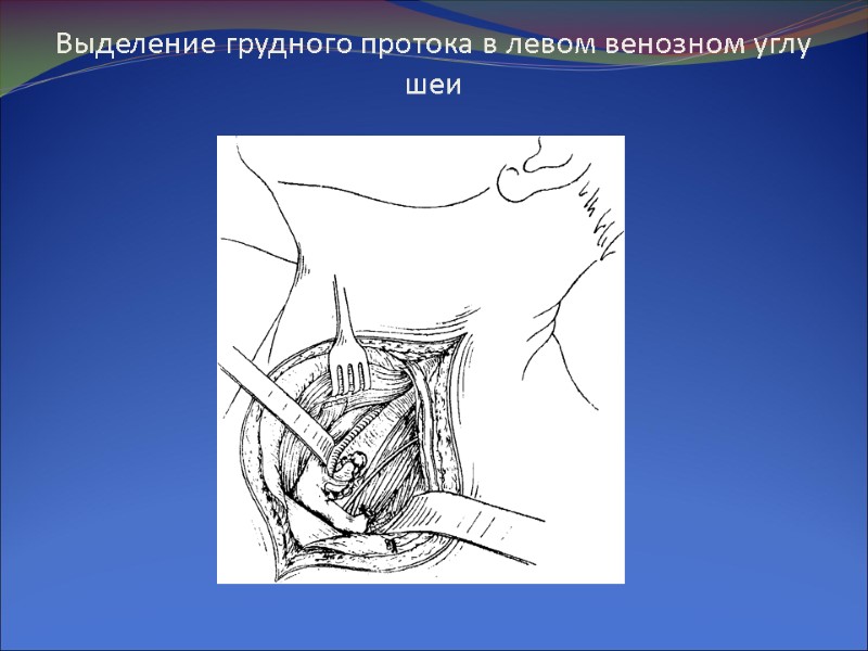 Выделение грудного протока в левом венозном углу шеи